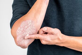 Apply the cream to the skin damaged by psoriasis