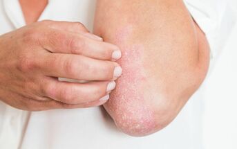 Psoriasis with constant itching