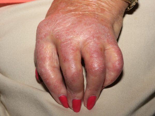 Manifestations of hand psoriasis
