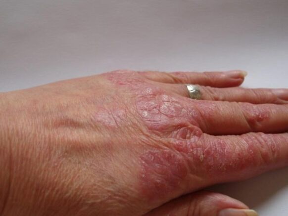 Psoriasis plaques on hands