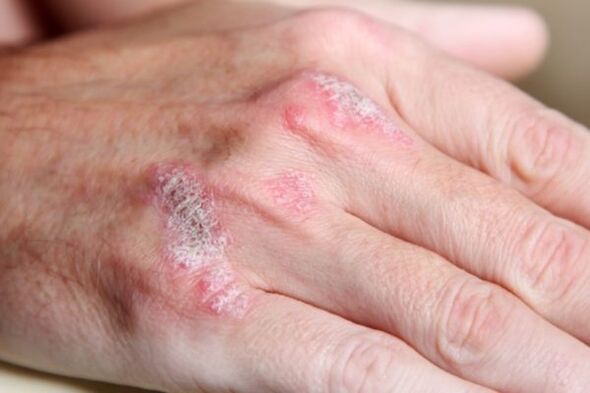 Psoriasis symptoms on the hands