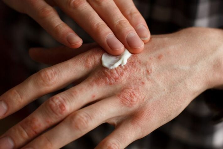 Treatment of psoriasis in children's hands