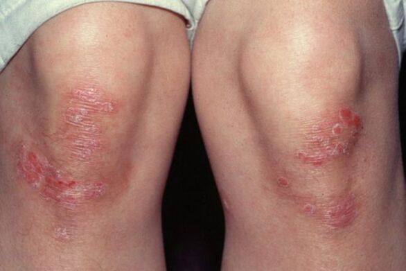 Psoriasis on the knee