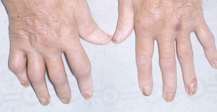 Joint disease psoriasis on the hand