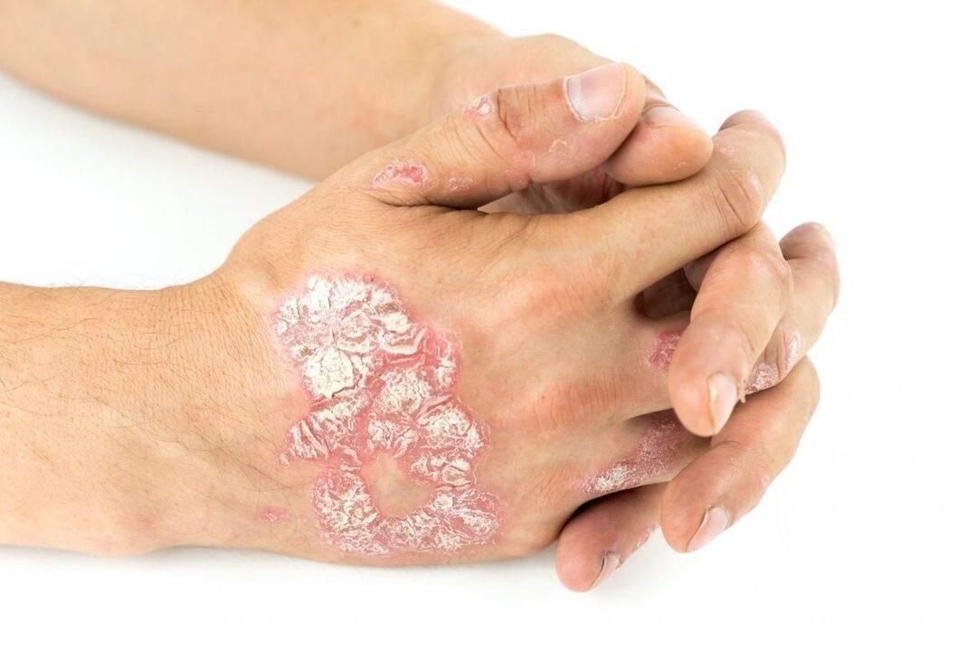 What does psoriasis on your hands look like