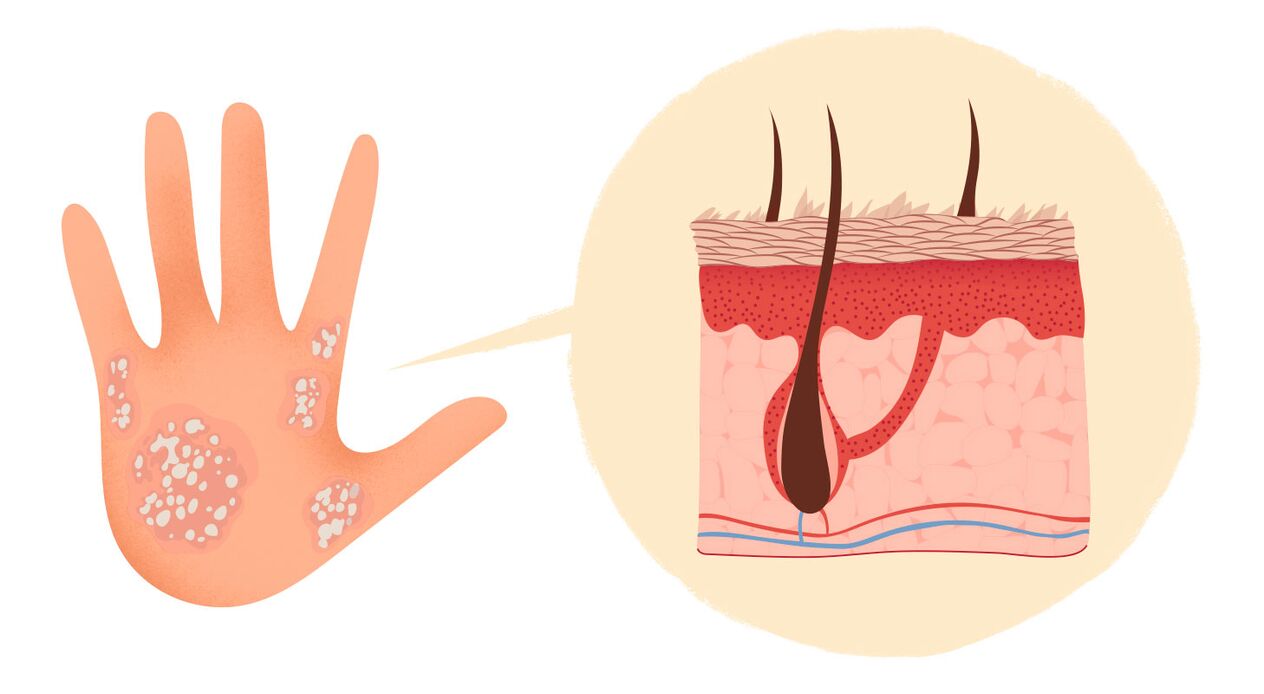 Signs of psoriasis on hands