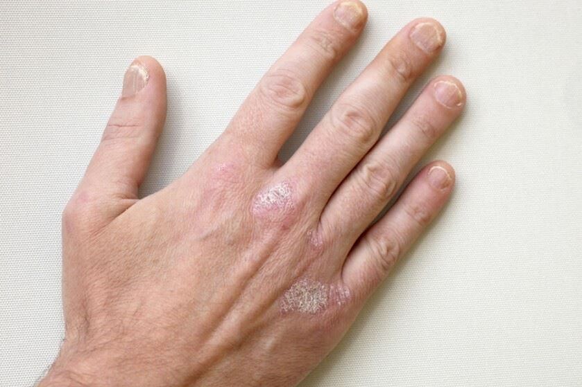 A mandatory symptom of psoriasis is the appearance of scaly patches on the skin