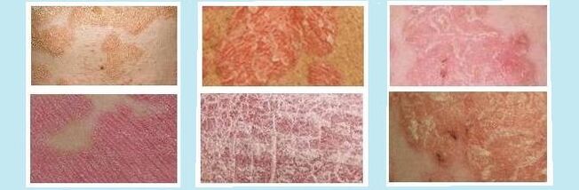 Rash characteristics of different types of psoriasis