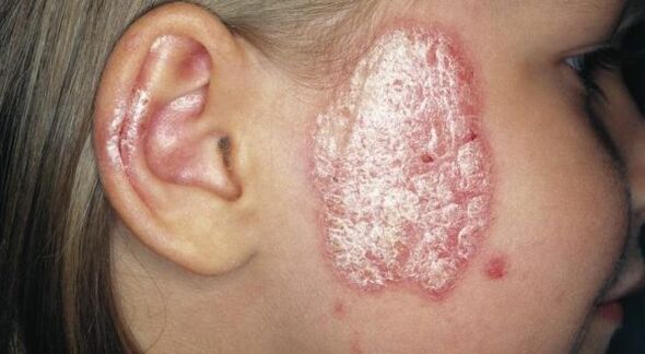 Psoriasis patches on face