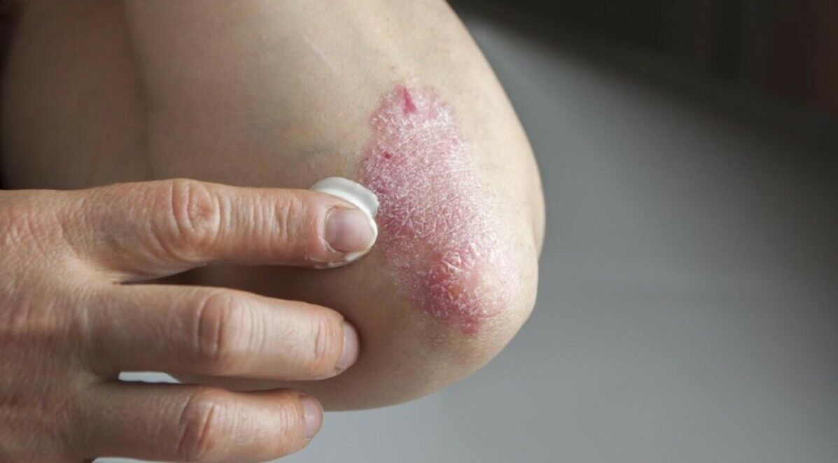 Psoriasis that affects the skin, treatment for which includes the use of ointments