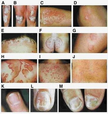 Symptoms of psoriasis depend on the type of disease