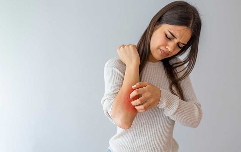 Psoriasis manifests as rash and itching