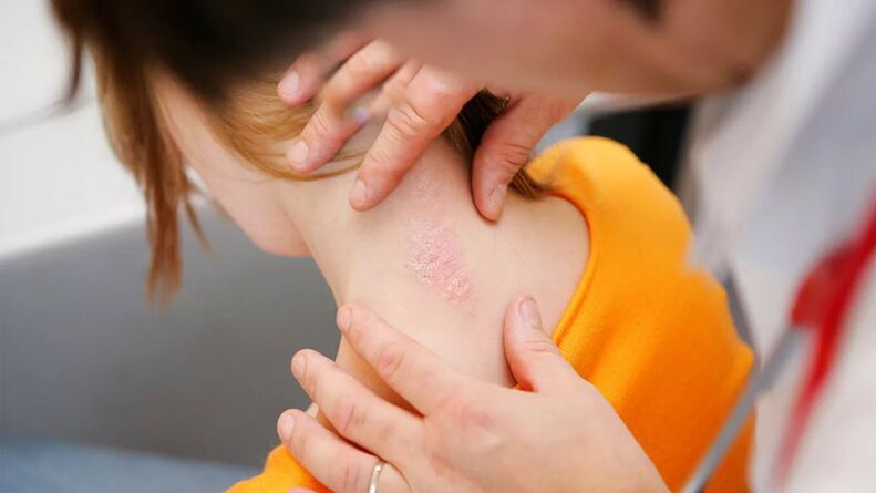 Psoriasis scales and plaques on the back of the neck
