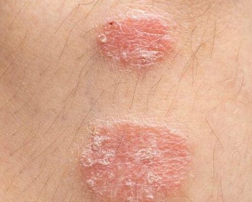 The appearance of psoriatic plaques