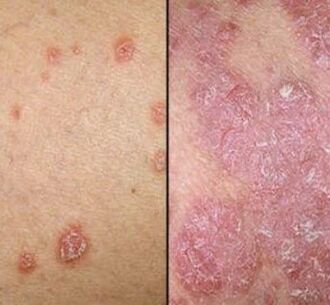Psoriasis plaques
