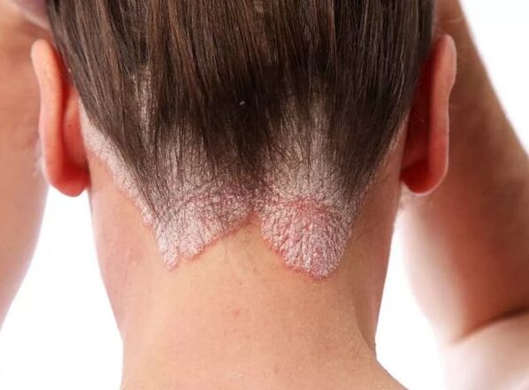 Psoriasis red skin