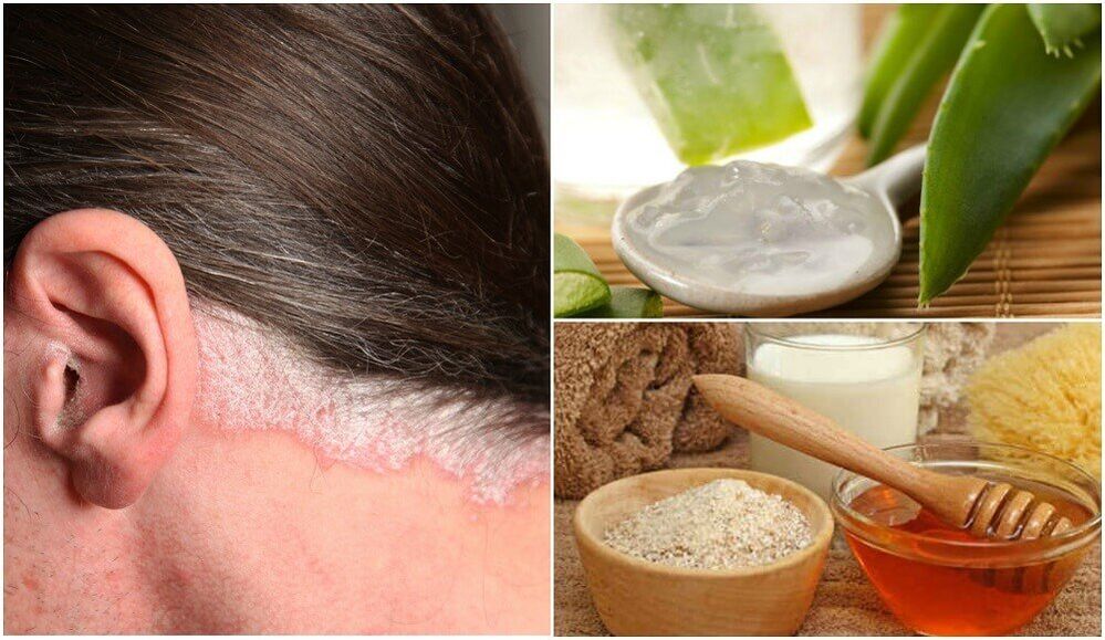 Treatment of psoriasis with folk therapy