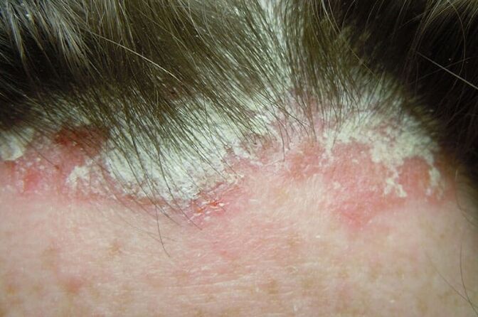 Psoriasis captures the hairy part of the entire head