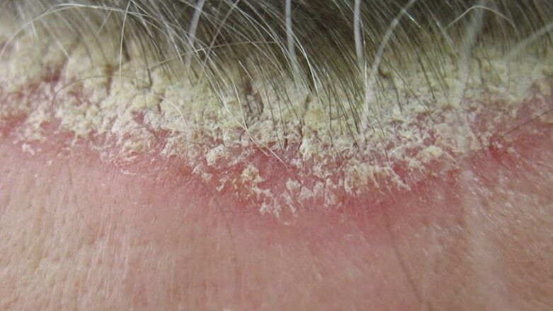 Psoriasis on the scalp