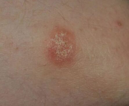 Psoriasis spots