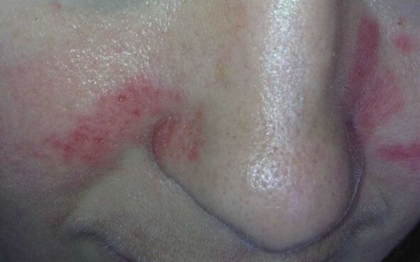 Symptoms of psoriasis