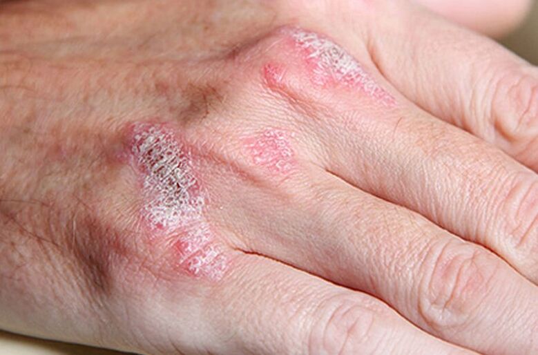 ladomary persistent psoriasis
