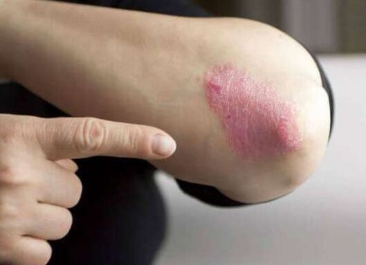 The fixation stage of psoriasis