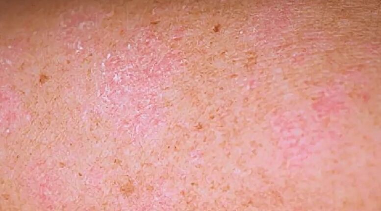 The return stage of psoriasis