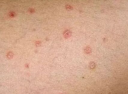 Initial Psoriasis