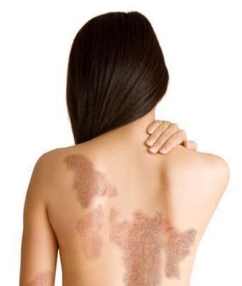 The stage of psoriasis, depending on the area of ​​the lesion
