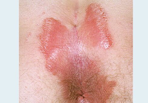 Close - Psoriasis