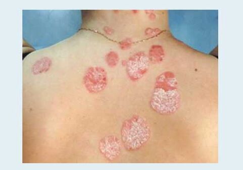 Common psoriasis