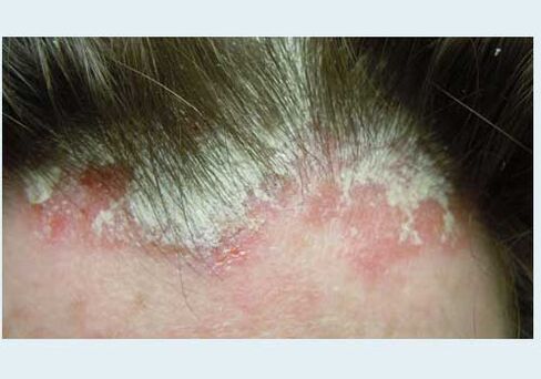 Damage to the head
