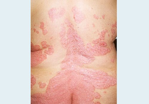 Psoriasis