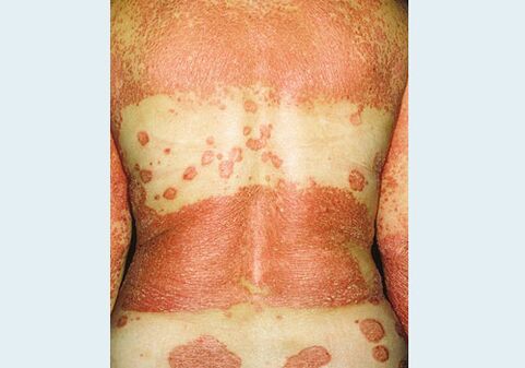 Reproductive psoriasis