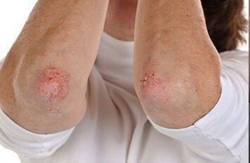 Psoriasis on the elbow