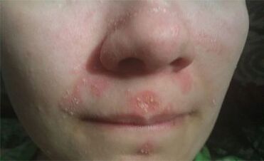 Psoriasis