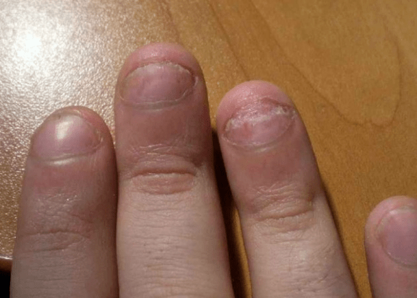 Psoriasis of nails