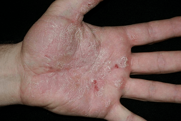 Psoriasis