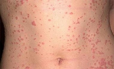 Psoriasis