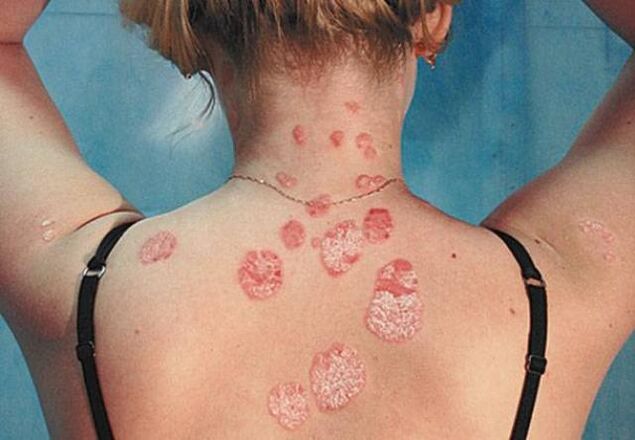 Back of psoriasis