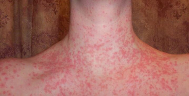 Psoriasis