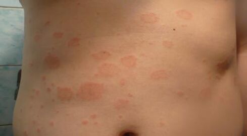Initial Psoriasis