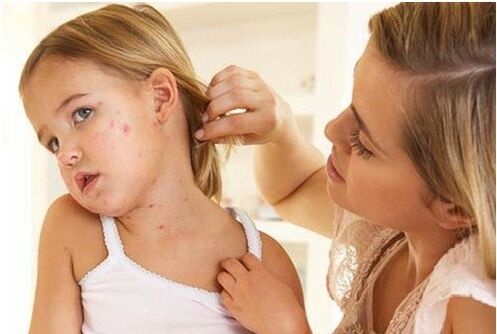 Photos of the initial stage of psoriasis