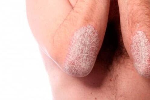 Elbow psoriasis