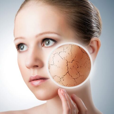 psoriasis on face