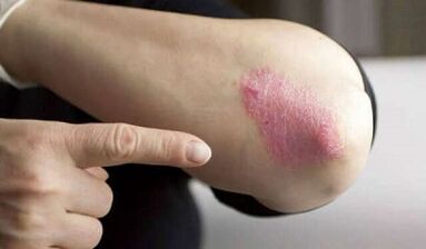 Quiescent stages of psoriasis development