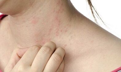Treatment of advanced psoriasis