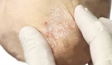 Treatment of psoriasis in its weakening phase