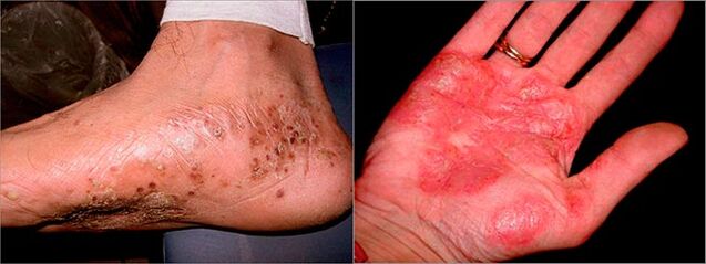 Palmoplantar psoriasis